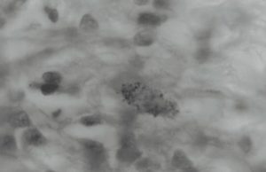 Béchamp’s Microzymas and Human Disease, Part 2: The Cancer Microbe