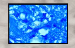 Coley’s Dramatic Cancer Cure, Part 6: Gallo Congratulates Cantwell (in Effect)