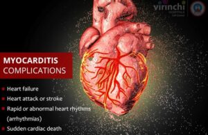 133x Risk of Myocarditis Post Vaccination