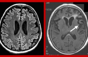 CJD Post-Vaccine — “…Like Watching Something Eat Her Brain Alive”